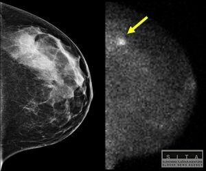 Mnohm enm zbytone lieia rakovinu prsnka, tvrd tdia